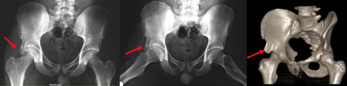 Resim-4: 17 yaşında erkek hasta, 3 yıl önce geçirilmiş AİİS avülsiyon kırığı sonrası gelişen R kalça subspine sıkışma + CAM tipi FAS, Hastaya çekilen grafiler ve 3 boyutlu BT’de patolojik AİSS (kırmızı ok) görülmekte. 