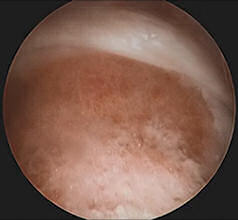 Resim 8: Femoro-asetabuler sıkışma hastalığında periferik kompartmanda tümsek lezyonunun düzeltilmesi