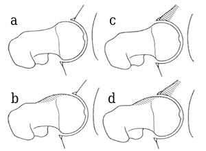 Şekil 1: Anormal morfoloji hareket esnasında eklem açıklığını değiştirerek anormal sürtünmeye neden olur. a. Normal kalça ve eklem açıklığı, b. Baş-boyun ofsetinin kaybolması femur boynunun asetabulum ön kenarına anormal sürtünmesine neden olur (femoral tip FAS), c. Asetabulumun femur başunu aşırı örtmesi de bir kıskaç etkisi oluşturur (Kıskaç tip - asetabulet tip FAS), d. Karışık tipte ise hem femoral hem de asetabuler tip FAS görülür. (Lavigne ve ark.dan) (2)