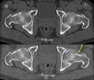 Resim 14: Bilateral cam lezyonu olan hastanın ameliyat öncesi ve sol tarafı ameliyat edildikten sonraki görüntüleri. Ameliyat öncesi belirgin olan baş-boyun off-set kaybı, solda ameliyat sonrası normal konturuna getirilmiş. 