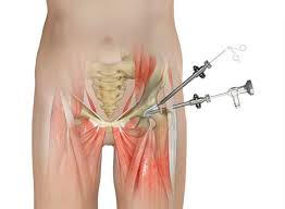 Resim 1: Kalça artroskopisi özel aletlerle yapılan küçük kesilerle yapılan bir cerrahi girişimdir.