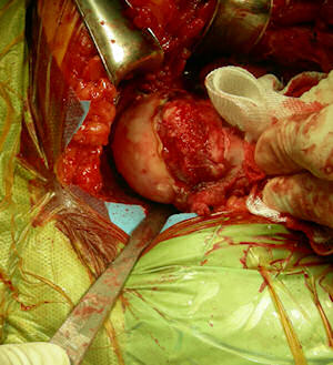 Resim1: Kalça disloke edildiğinde kaymanın şekli ve iyileşme  dokusunun görüntüsü